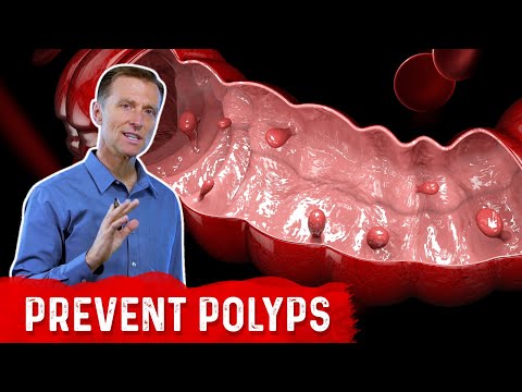 ¿Beber alcohol puede causar pólipos en el colon?